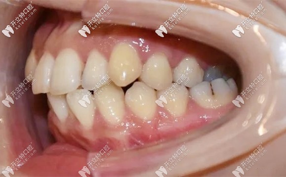 矯正前牙齒的側(cè)面樣子