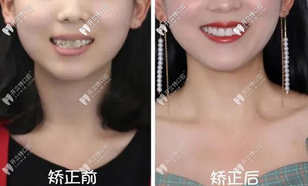哇~22歲重度齙牙的我做了正雅日夜版隱形矯正竟然逆襲！
