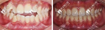 矯正牙齒前后對比
