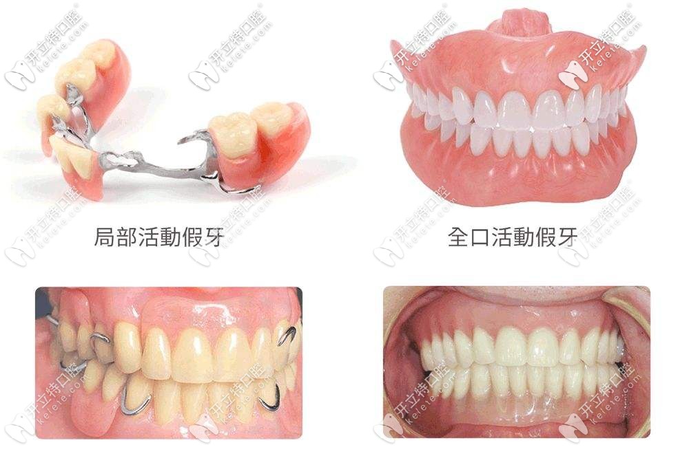 目前先進(jìn)的活動(dòng)義齒:純鈦支架,維他靈,吸附性義齒有啥區(qū)別