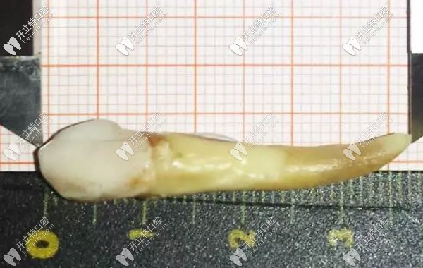 人的智齒較長有幾厘米，3.72厘米的牙齒你見過嗎？