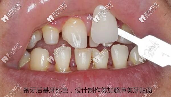 備牙后基牙比色，設(shè)計制作美加超薄美牙貼面