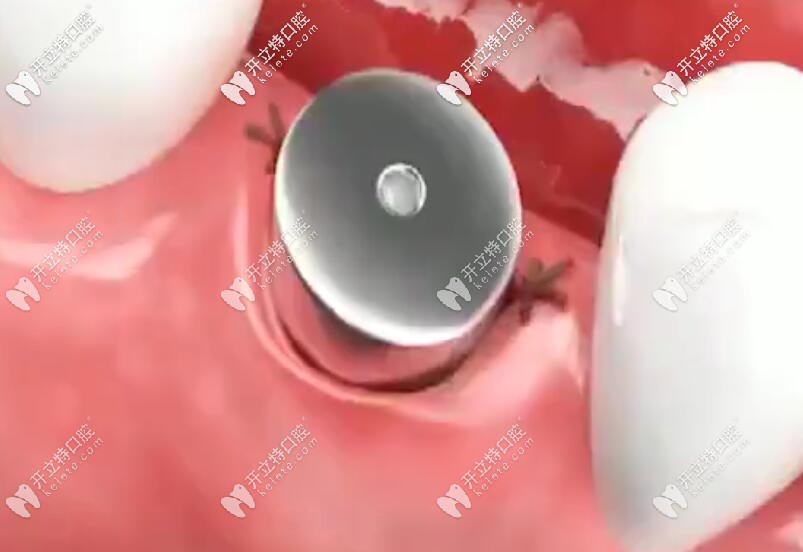 安裝愈合基臺，縫合傷