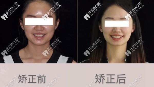 記錄我牙齒內(nèi)傾使用進(jìn)口隱適美牙套矯正兩年的過(guò)程 