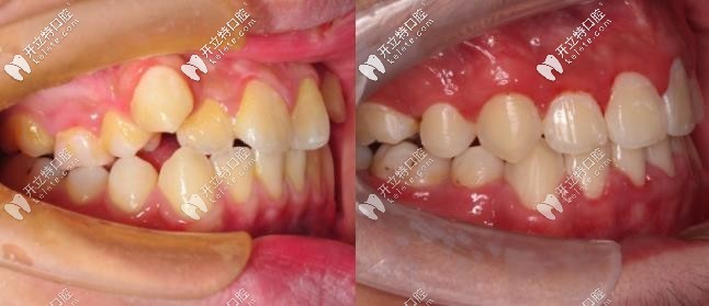 輕度骨性地包天戴進口金屬自鎖牙套矯正案例更新,不手術(shù)哦