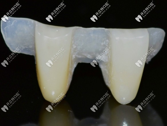 馬里蘭橋修復義齒適應哪些牙,為啥網(wǎng)傳馬里蘭橋被淘汰了？
