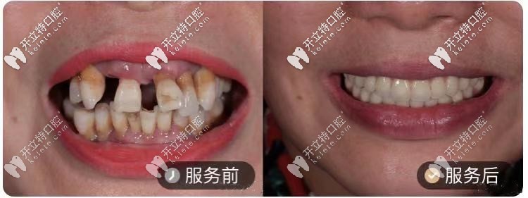 50歲阿姨，做的ALL-ON-4種植牙對比圖