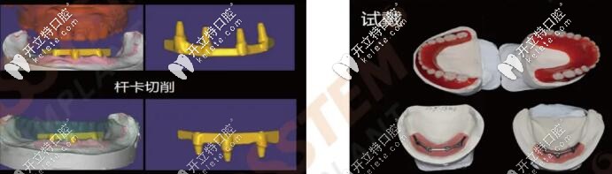全口桿卡式種植牙手術(shù)過(guò)程