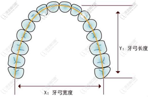 8-14歲的兒童使用牙齒擴弓的費用大概是多少？