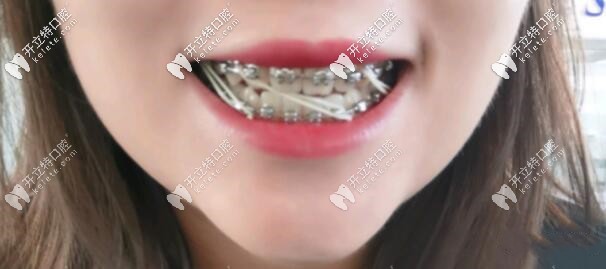 牙齒矯正：要經歷皮筋牽引階段的