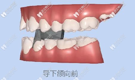 達(dá)芬奇牙套有效促進(jìn)下頜骨發(fā)育