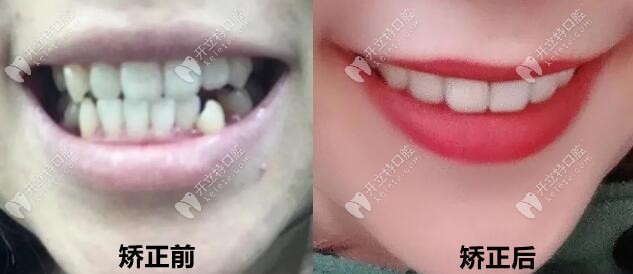 通過3年矯正變化，現在我的牙齒美美噠