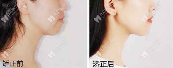 露齦笑戴陶瓷半隱形矯正有效果嗎？親身整牙經(jīng)歷來解答~