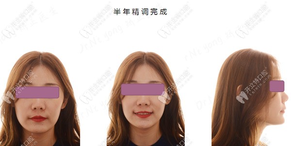 過了半年了，臉型還是有點變化的喲