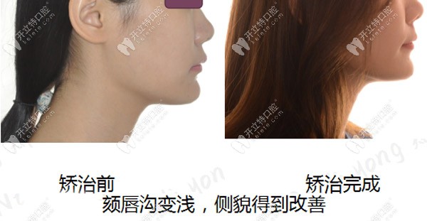 深覆合矯正后頦唇溝變淺，側臉有了明顯的改善