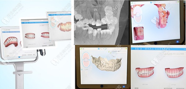 隱形矯正的三維動(dòng)畫圖